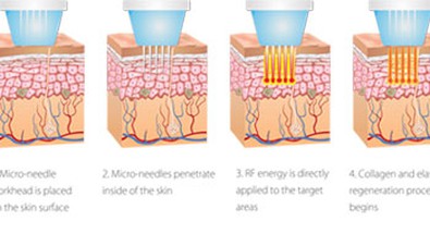 Er Fractional RF sikkert for alle hudtyper?